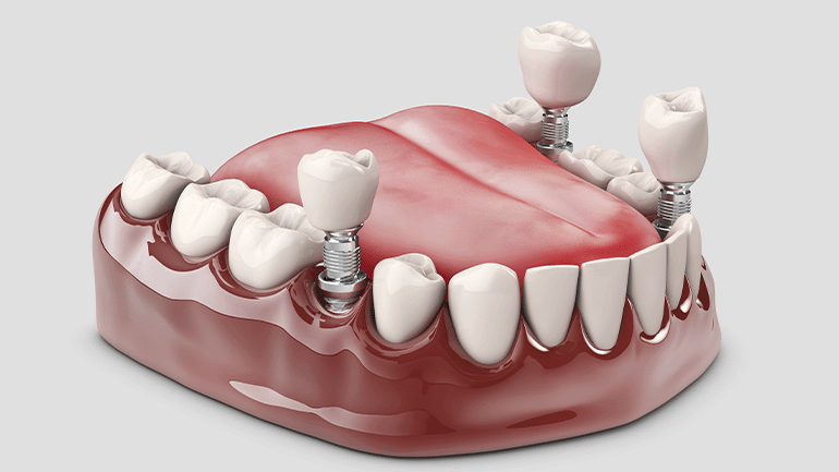 How to Prepare for Dental Implant Surgery